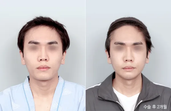 Before/After