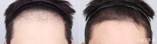 Before/After