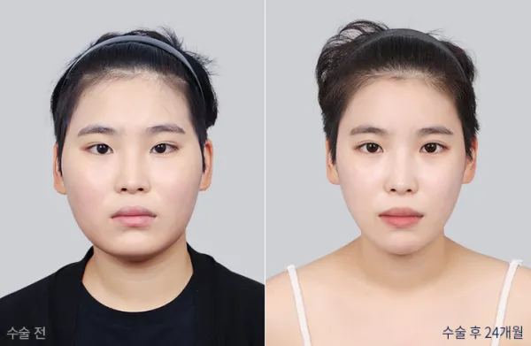 Before/After