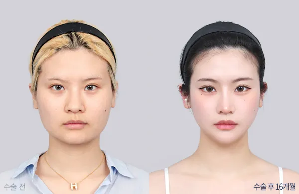 Before/After