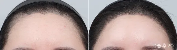 Before/After