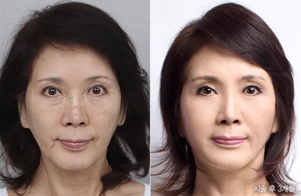 Before/After