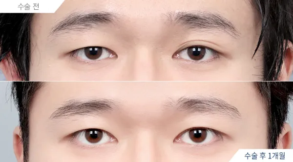 Before/After