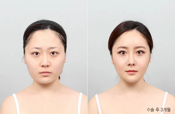 Before/After