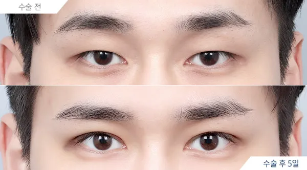 Before/After