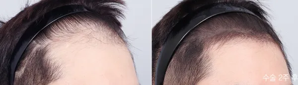 Before/After