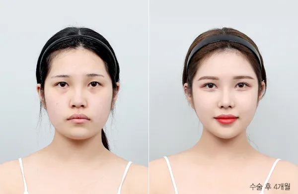 Before/After