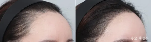 Before/After