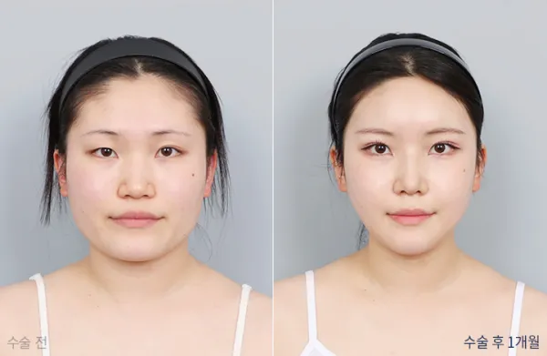 Before/After