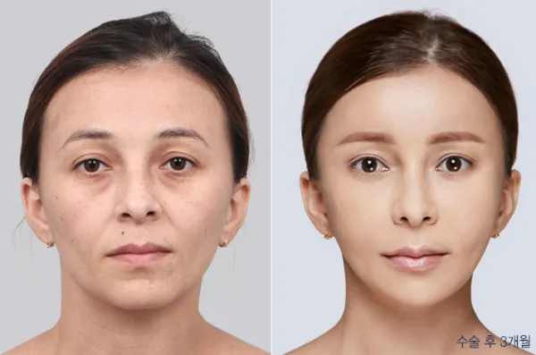 Before/After
