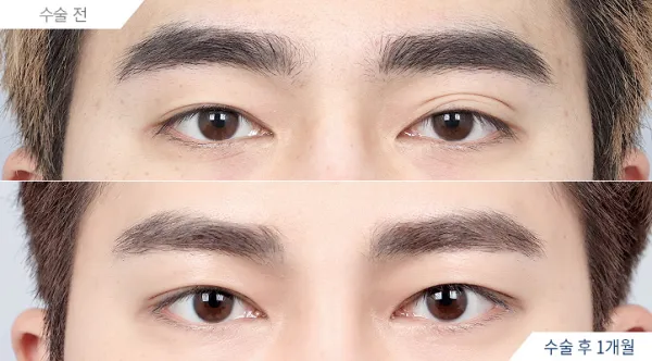 Before/After
