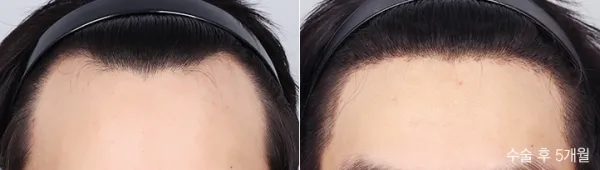 Before/After