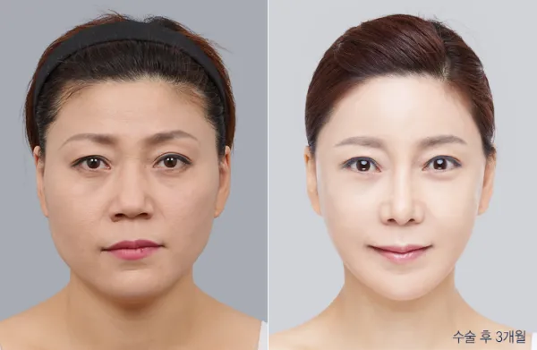 Before/After