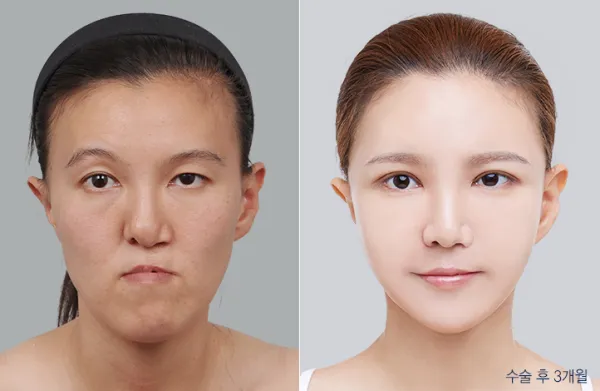 Before/After
