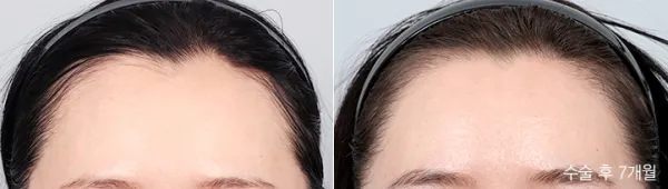 Before/After