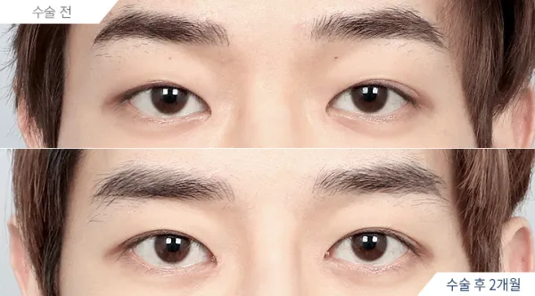 Before/After