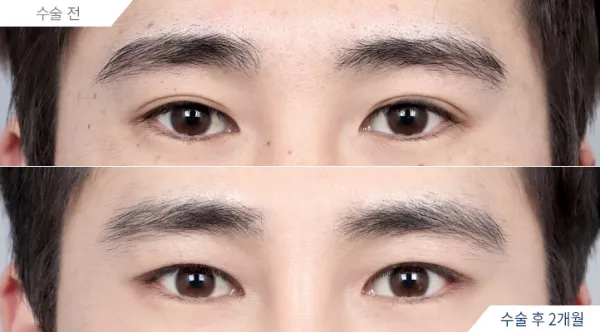 Before/After