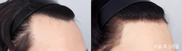 Before/After