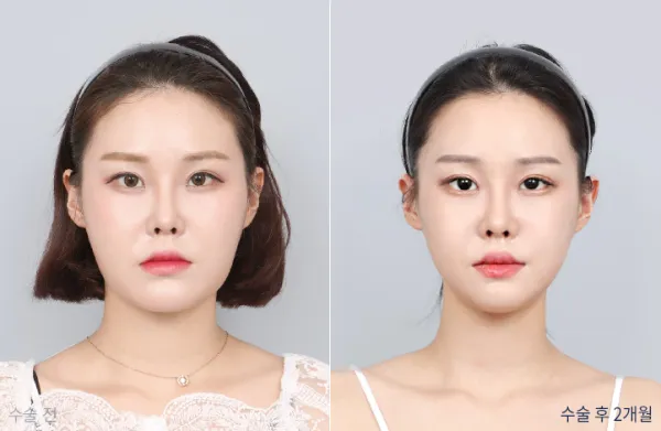 Before/After