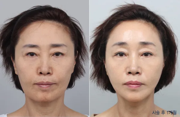 Before/After