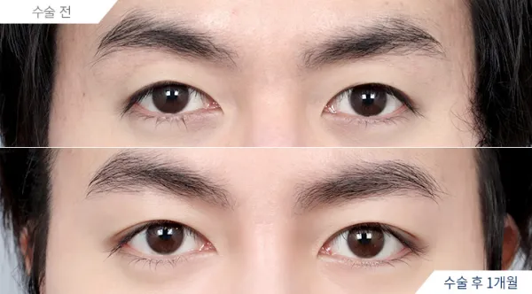 Before/After