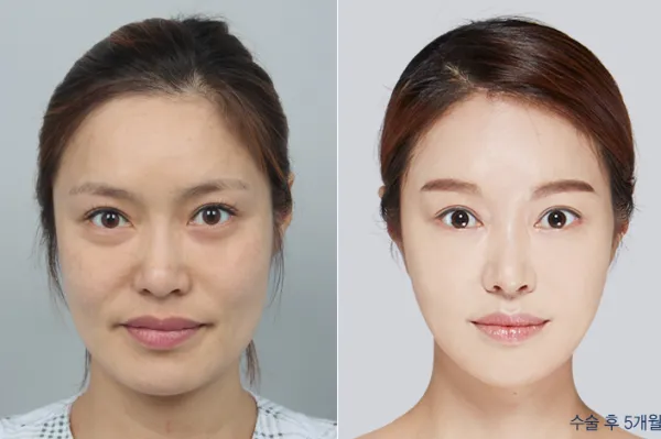 Before/After