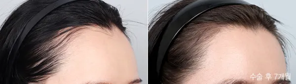 Before/After