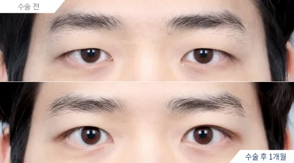 Before/After