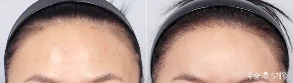 Before/After