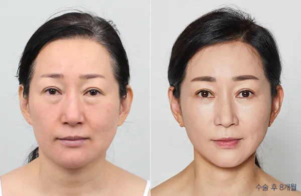 Before/After