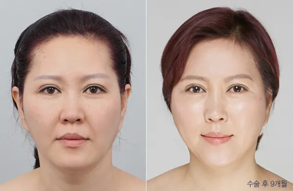 Before/After