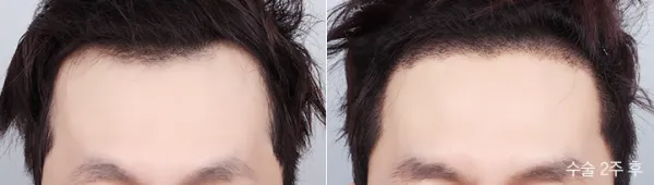 Before/After