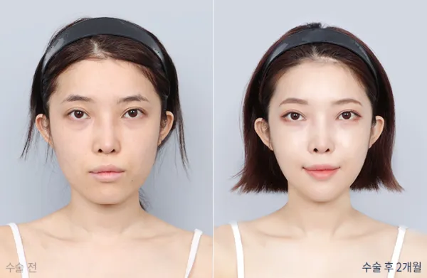 Before/After
