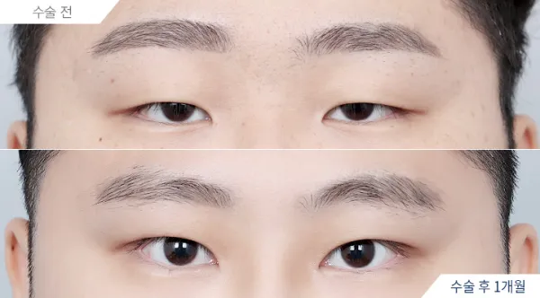 Before/After