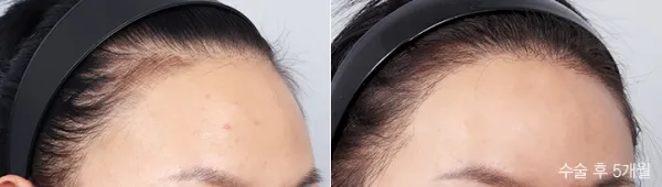 Before/After