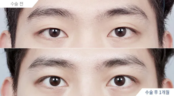 Before/After