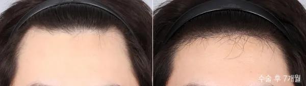Before/After