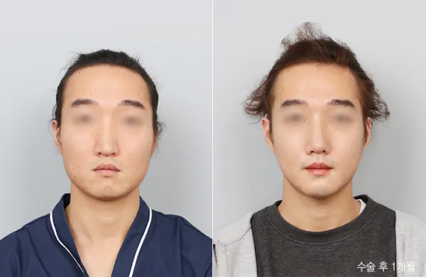 Before/After