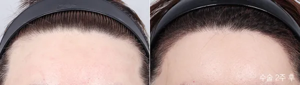 Before/After