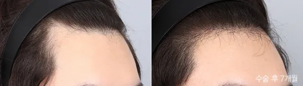 Before/After
