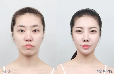 Before & After
