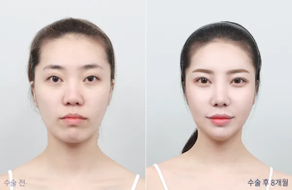 Before/After
