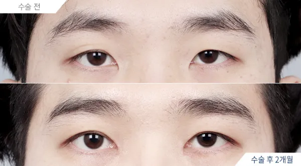 Before/After