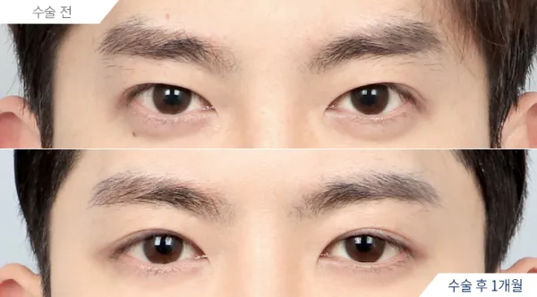 Before/After