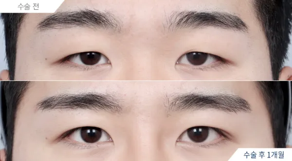 Before/After