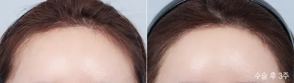 Before/After