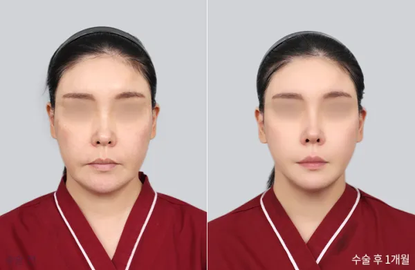 Before/After