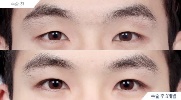 Before/After