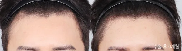 Before/After
