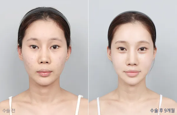 Before/After